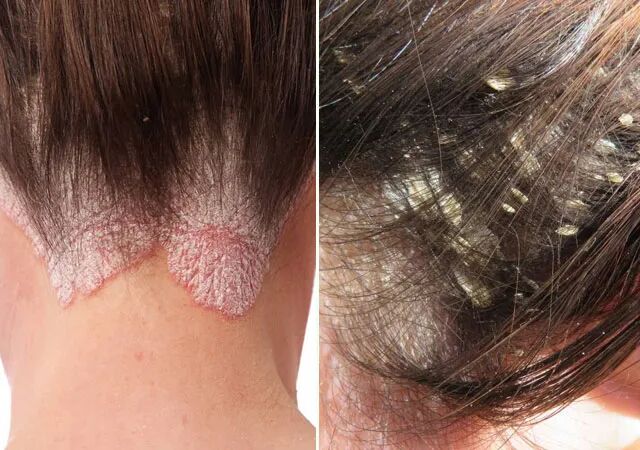 如何区分头皮屑和头皮牛皮癣