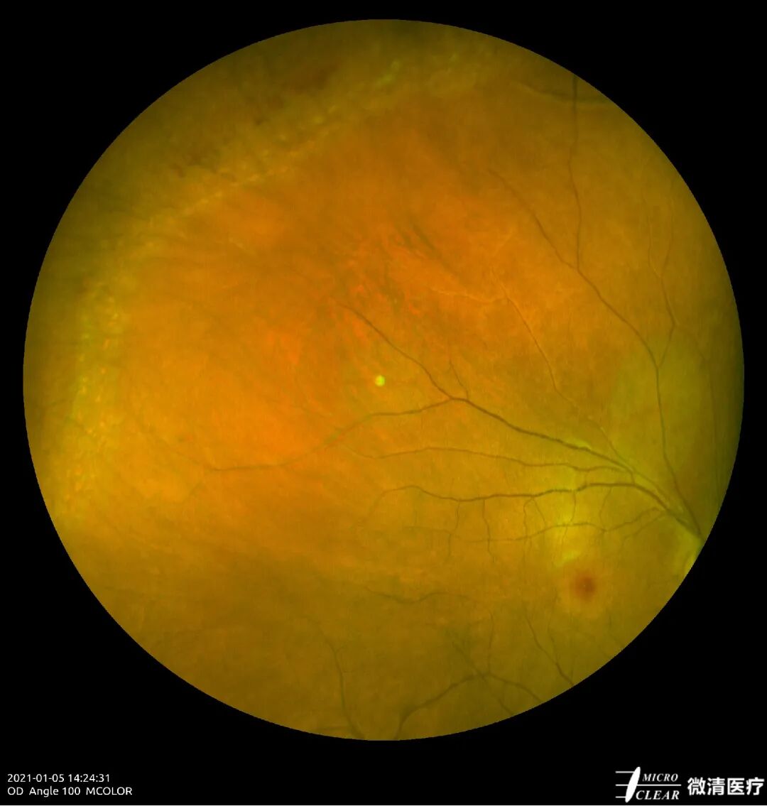 怎么看眼底相机微清Apollo相机，揭开白内障眼底的神秘面纱_https://www.jmylbn.com_新闻资讯_第8张