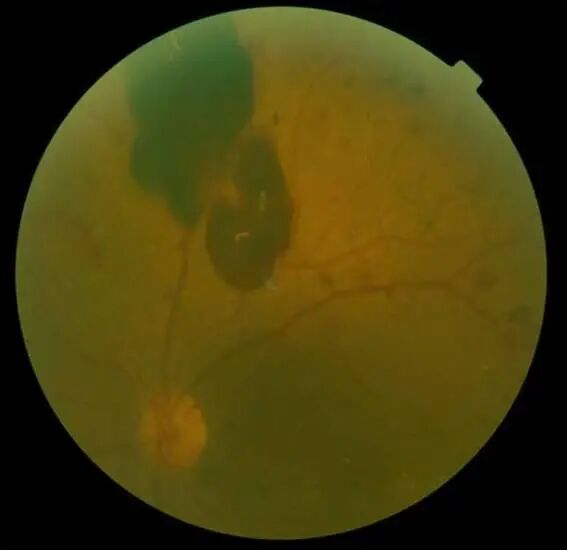 怎么看眼底相机微清Apollo相机，揭开白内障眼底的神秘面纱_https://www.jmylbn.com_新闻资讯_第12张