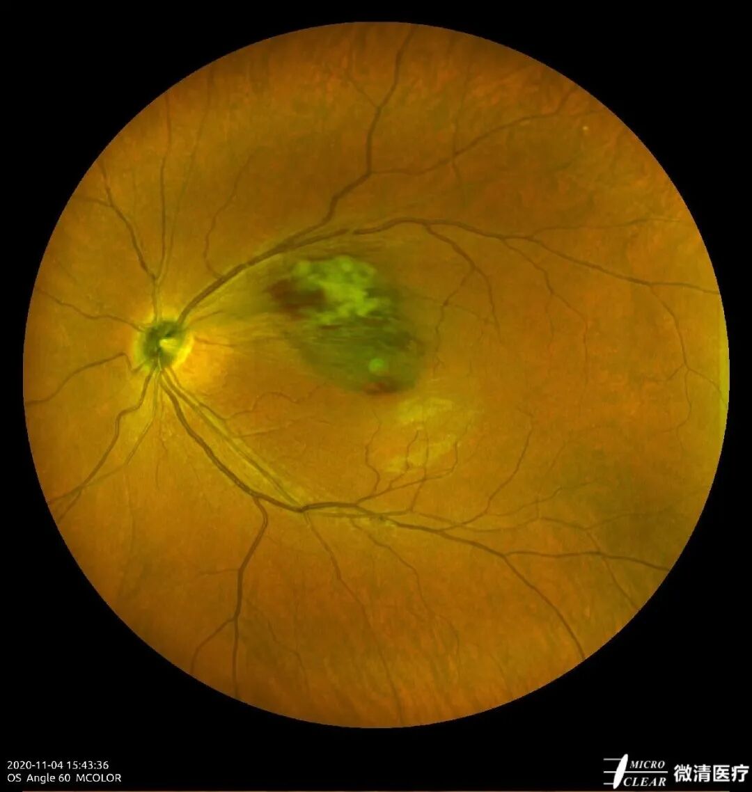 怎么看眼底相机微清Apollo相机，揭开白内障眼底的神秘面纱_https://www.jmylbn.com_新闻资讯_第7张