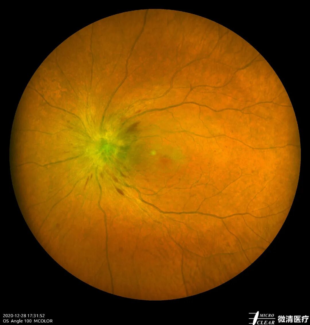 怎么看眼底相机微清Apollo相机，揭开白内障眼底的神秘面纱_https://www.jmylbn.com_新闻资讯_第4张