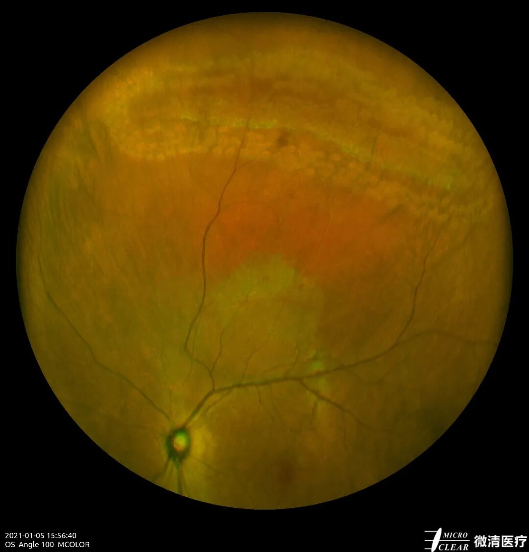 怎么看眼底相机微清Apollo相机，揭开白内障眼底的神秘面纱_https://www.jmylbn.com_新闻资讯_第9张