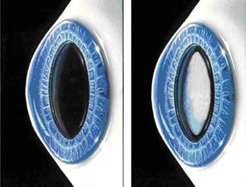 怎么看眼底相机微清Apollo相机，揭开白内障眼底的神秘面纱_https://www.jmylbn.com_新闻资讯_第1张