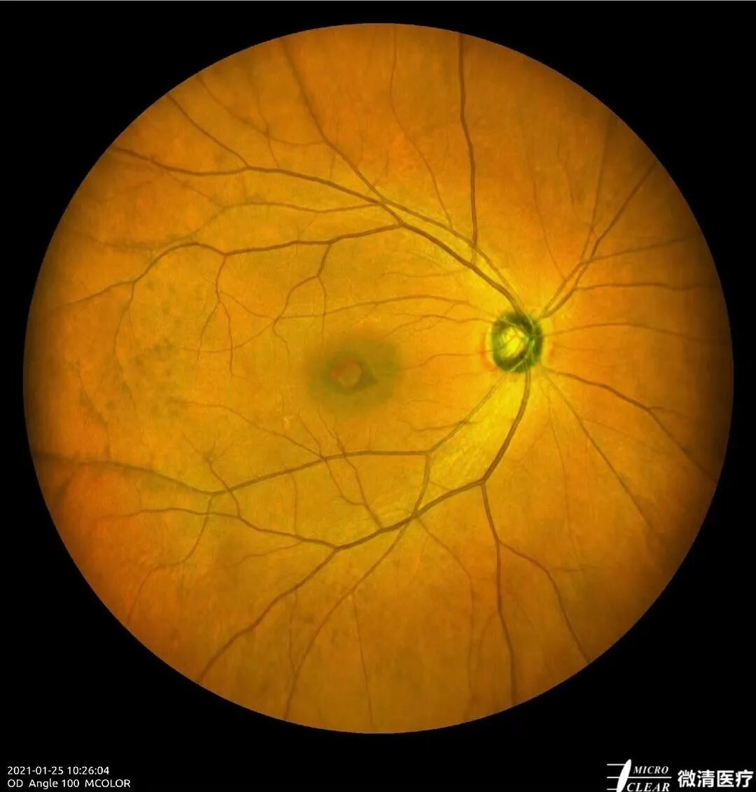 怎么看眼底相机微清Apollo相机，揭开白内障眼底的神秘面纱_https://www.jmylbn.com_新闻资讯_第5张
