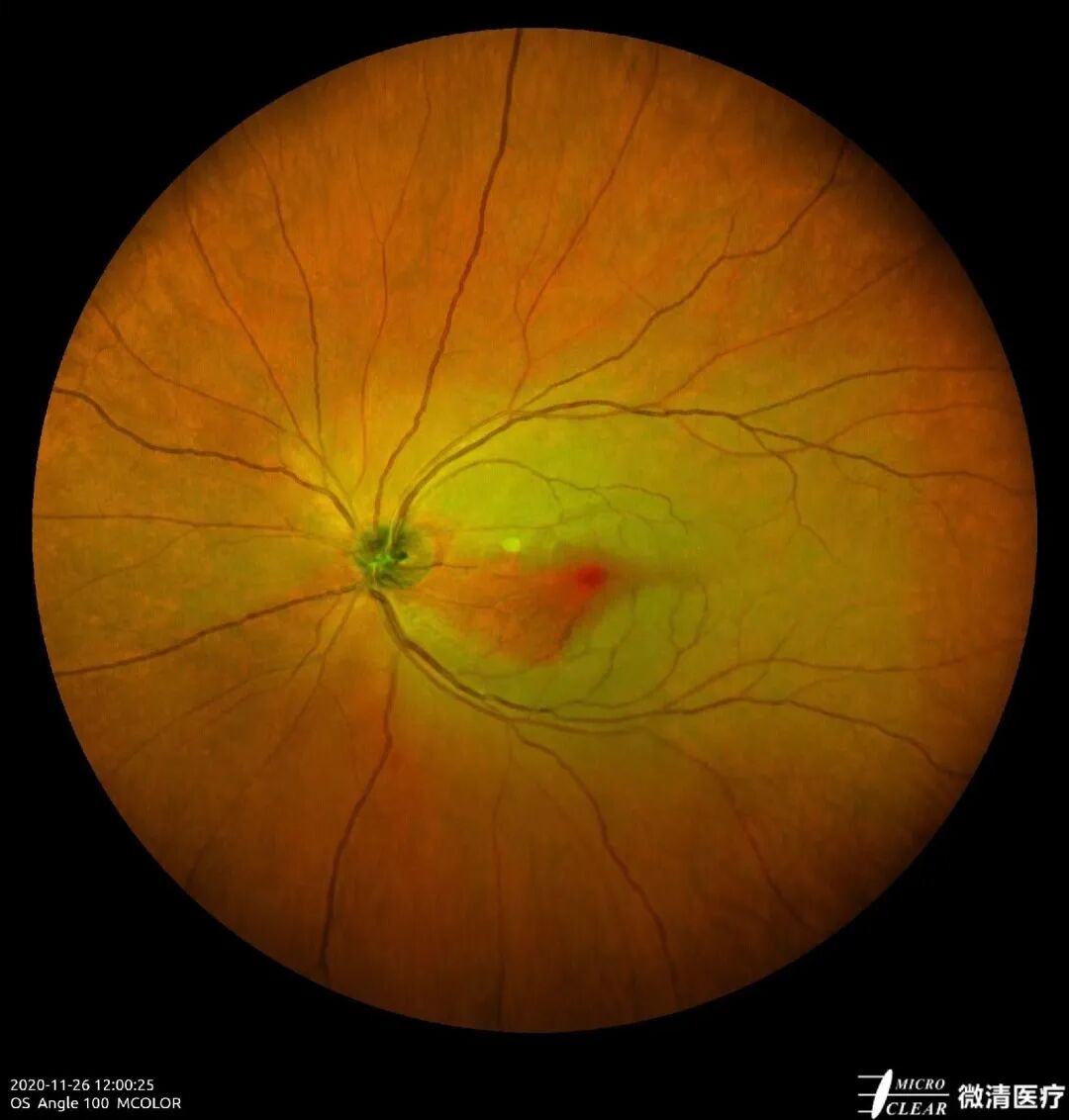 怎么看眼底相机微清Apollo相机，揭开白内障眼底的神秘面纱_https://www.jmylbn.com_新闻资讯_第6张