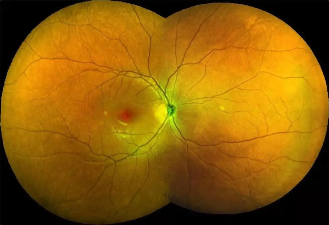 怎么看眼底相机微清Apollo相机，揭开白内障眼底的神秘面纱_https://www.jmylbn.com_新闻资讯_第15张