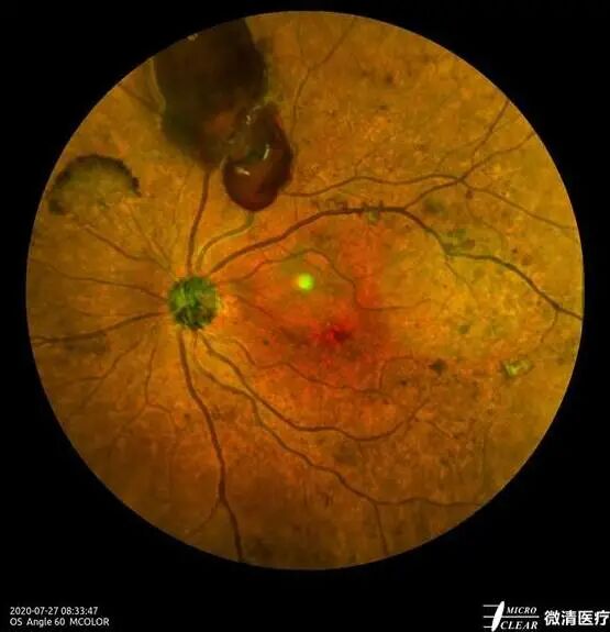 怎么看眼底相机微清Apollo相机，揭开白内障眼底的神秘面纱_https://www.jmylbn.com_新闻资讯_第13张