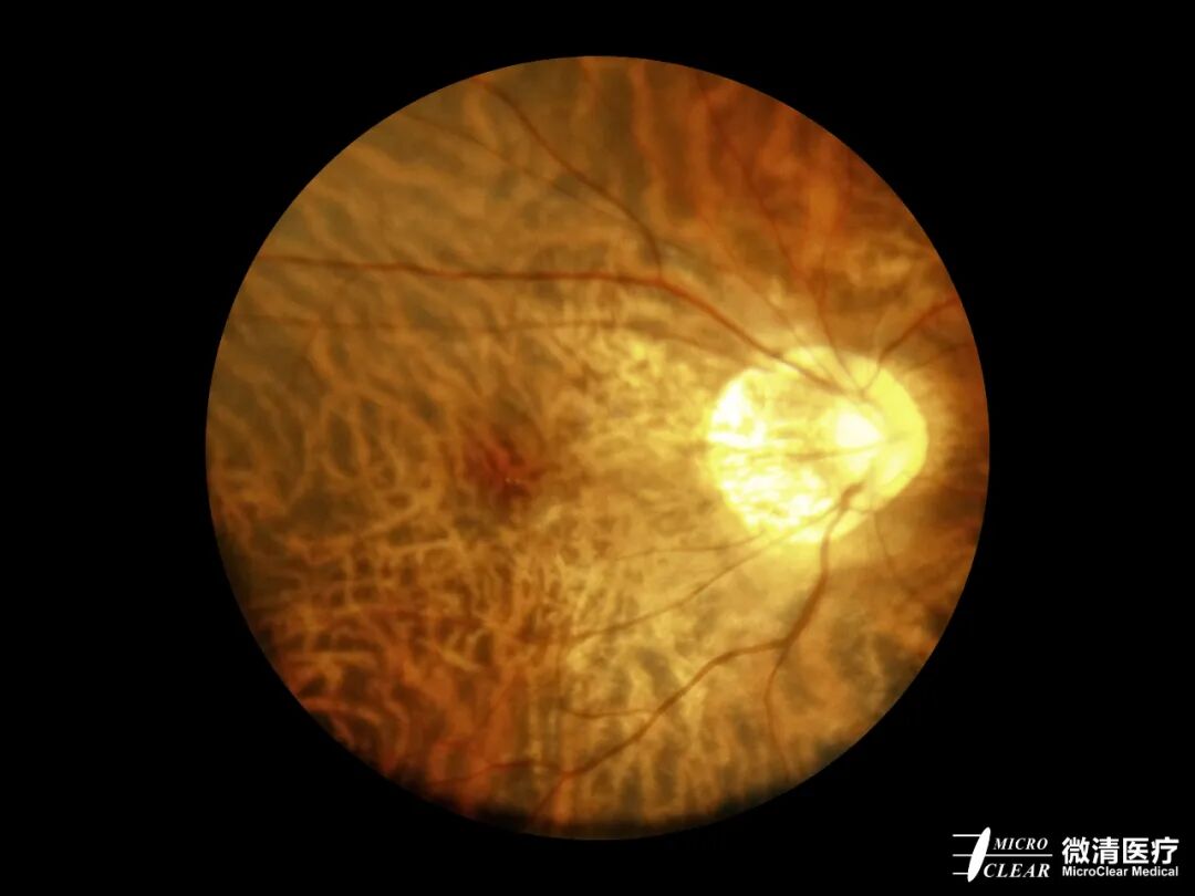 手持眼底相机怎么用“视”关重要——眼底照相检查_https://www.jmylbn.com_新闻资讯_第17张