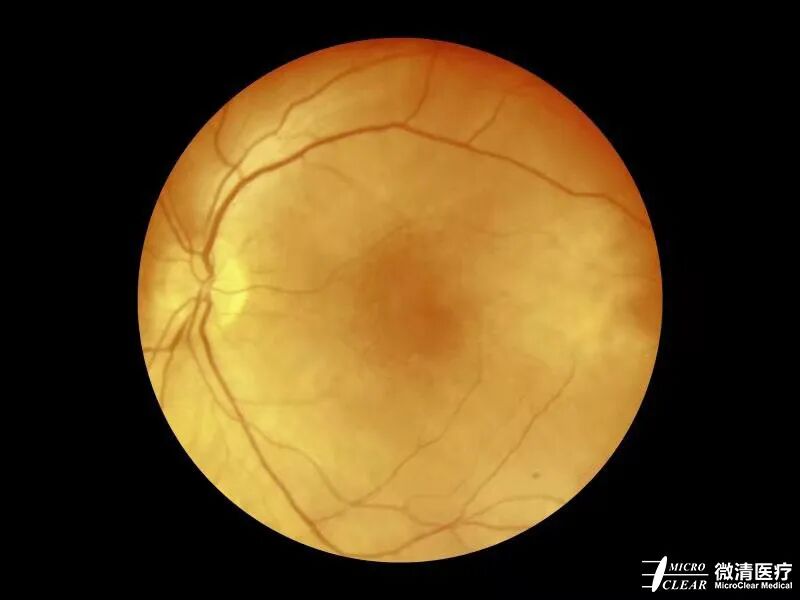 手持眼底相机怎么用“视”关重要——眼底照相检查_https://www.jmylbn.com_新闻资讯_第14张
