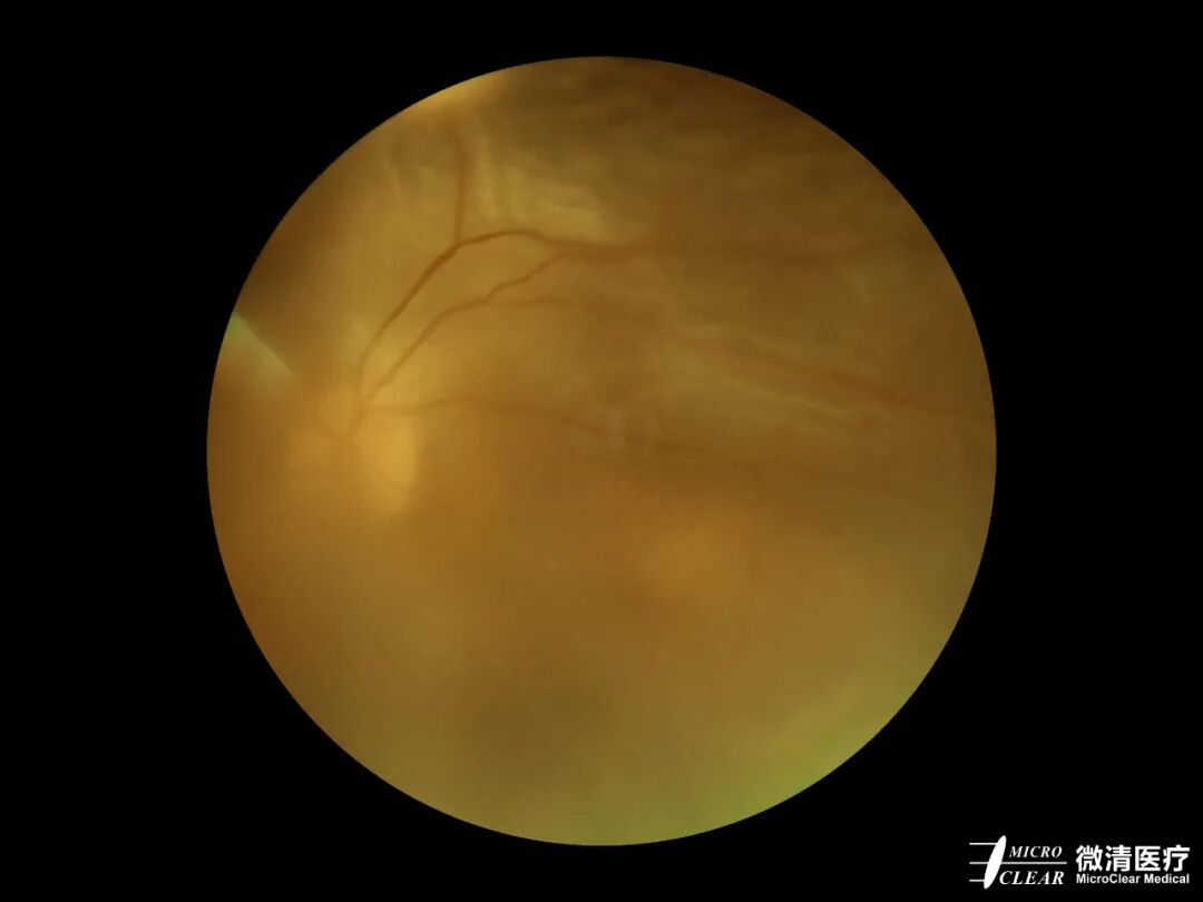 手持眼底相机怎么用“视”关重要——眼底照相检查_https://www.jmylbn.com_新闻资讯_第16张