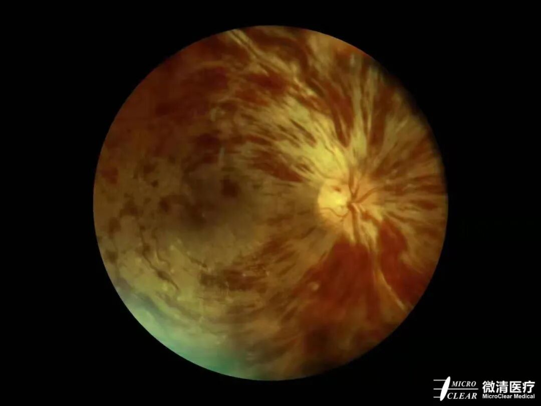 手持眼底相机怎么用“视”关重要——眼底照相检查_https://www.jmylbn.com_新闻资讯_第15张