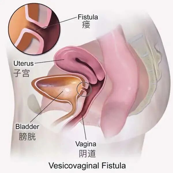 阴道扩张器干什么用妇科检查用的「窥阴器」，你真的了解吗？_https://www.jmylbn.com_新闻资讯_第15张