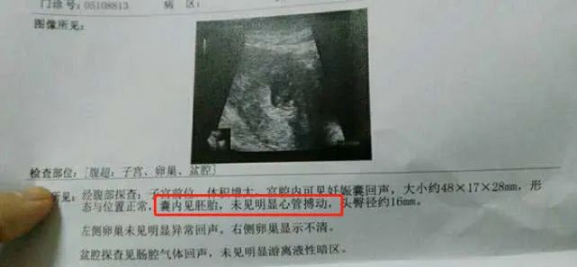 喝水有助于孕囊排出吗_孕囊偏小和喝水少有关系吗_孕囊偏小医生让多喝水