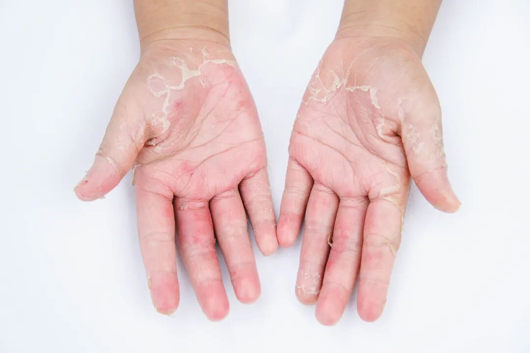 妇科荧光检查是什么会发“光”的技术：”真菌荧光检测“——汾阳医院皮肤性病科实验室成功开展“真菌荧光检测”新项目_https://www.jmylbn.com_新闻资讯_第3张