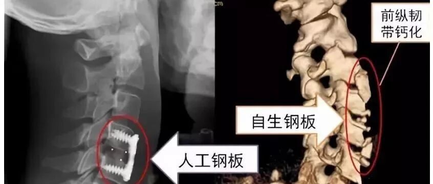 颈椎病诊治的十大误区，害惨很多人！