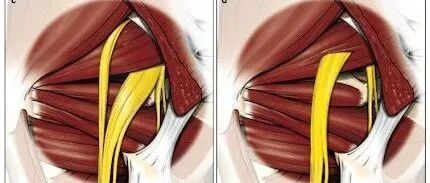 别让梨状肌背黑锅，它不是压迫坐骨神经的唯一真凶！