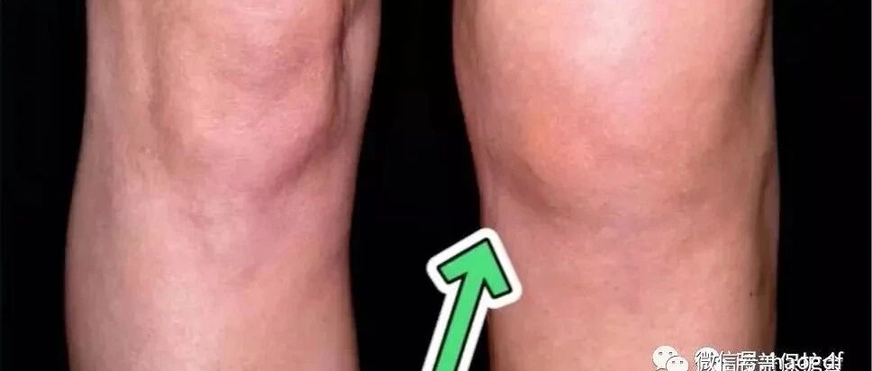 膝盖退化的这三种征兆，用肉眼就能看出！