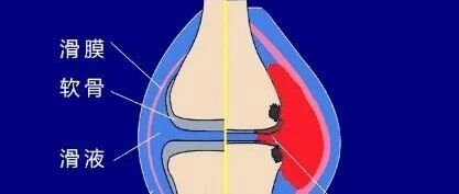 夫妻俩膝盖都坏了，竟是因为这个坚持10年的“好习惯”！