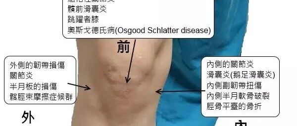 膝盖痛的简易鉴别
膝盖痛的简易鉴别