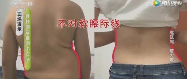 脊柱侧弯有多吓人？看完这个，保证你绝对立马坐正！