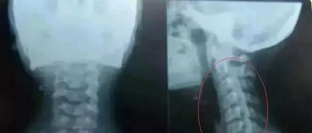 颈椎病不可怕，最怕颈椎生理曲度变直！