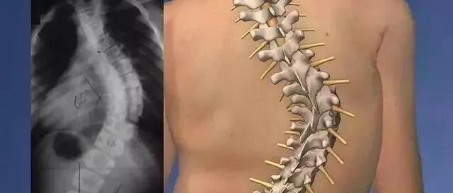 详细分析脊柱侧弯的恐怖