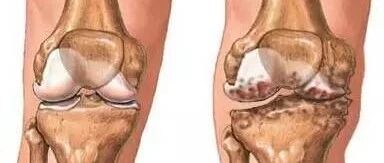 骨刺不是病，不要被骗了，40岁后必看~