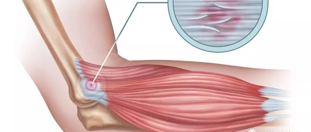 你的肌腱炎为什么休息无法缓解？