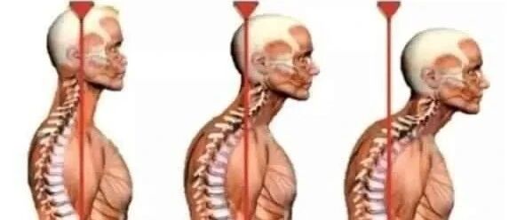 颈后大包如何系统康复纠正？