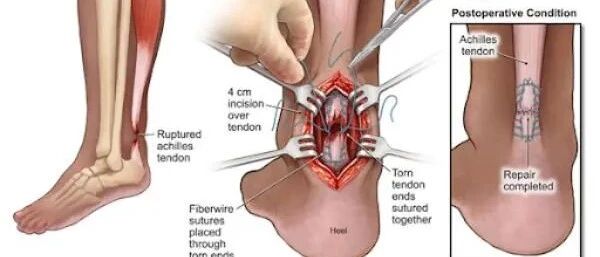 易建联顶着疫情去美国，中美康复治疗差距这么大？