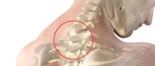 头颈夹肌和“颈后大包”（富贵包）不得不说的故事！