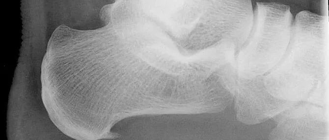 你认为的骨刺真相是这样的