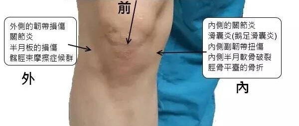 膝盖痛的简易鉴别