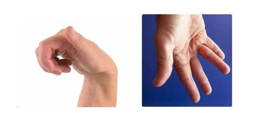 肌痉挛的康复治疗