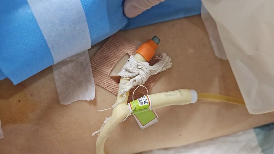 为什么要引流尿袋做手术插尿管，这种感觉“酸爽”吗，需要注意哪些问题？_https://www.jmylbn.com_新闻资讯_第15张