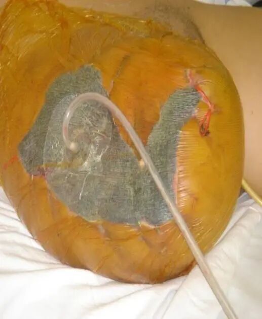 为什么负压引流科普丨VSD负压封闭引流技术，让患者创面更快痊愈_https://www.jmylbn.com_新闻资讯_第6张