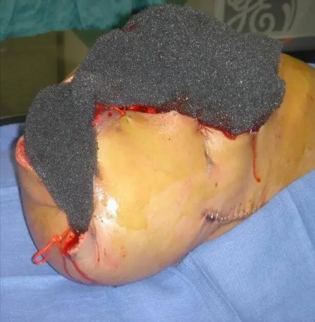 为什么负压引流科普丨VSD负压封闭引流技术，让患者创面更快痊愈_https://www.jmylbn.com_新闻资讯_第5张