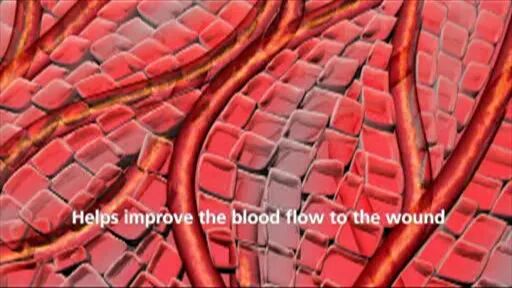 为什么负压引流科普丨VSD负压封闭引流技术，让患者创面更快痊愈_https://www.jmylbn.com_新闻资讯_第8张