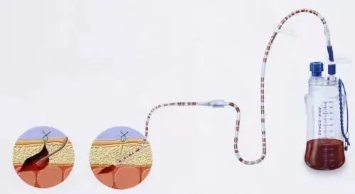 为什么负压引流科普丨VSD负压封闭引流技术，让患者创面更快痊愈_https://www.jmylbn.com_新闻资讯_第2张