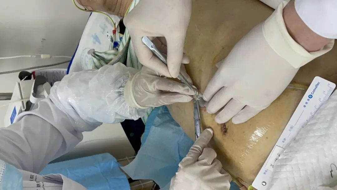 为什么负压引流科普丨VSD负压封闭引流技术，让患者创面更快痊愈_https://www.jmylbn.com_新闻资讯_第12张