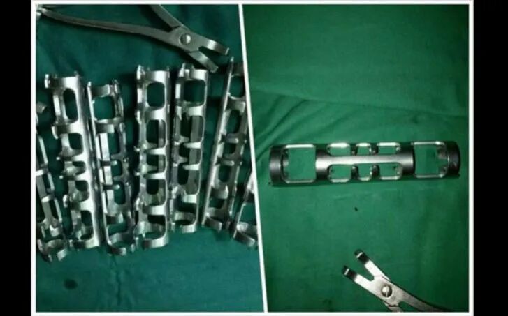 肋骨怎么记忆肋骨骨折了怎么办？ 具有“记忆”的神奇钢板_https://www.jmylbn.com_新闻资讯_第5张