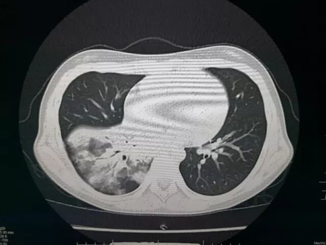 难治性支原体肺炎如何痊愈