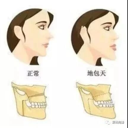 “地包天”有什么危害？什么年龄段治疗比较好？