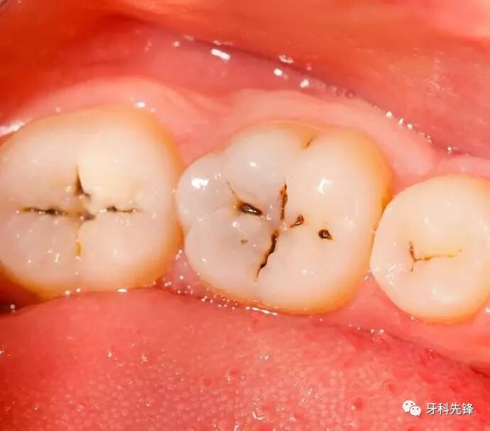 牙齿上有小黑点到失去牙齿要几步？