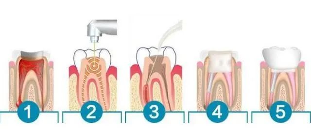 根管治疗多少钱一颗牙？为什么那么贵？