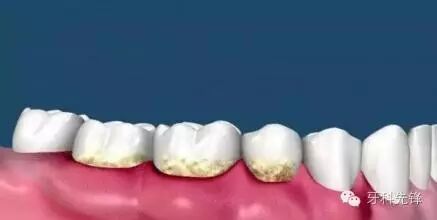 多长时间洗一次牙？洗牙后到底有什么禁忌？