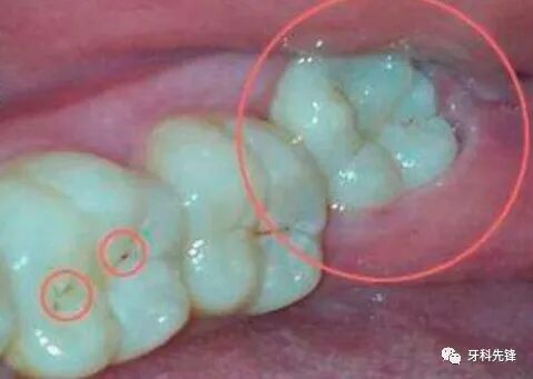 为什么牙医说我的智齿要分开几次拔，不能一次性拔完？