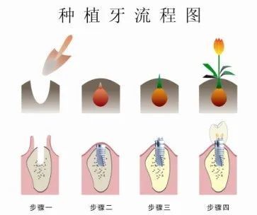 种植牙的全面介绍，值得收藏！