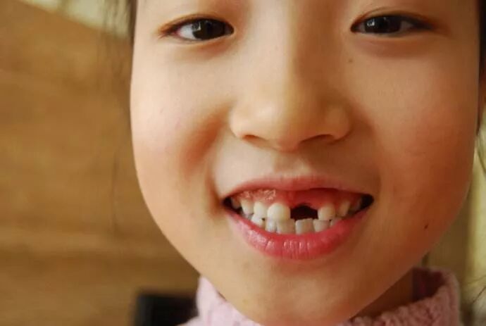 门牙磕掉了怎么办?最真实的经验分享