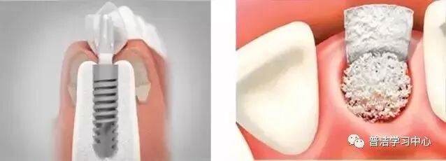 做个种植牙手为什么我还需要植骨？